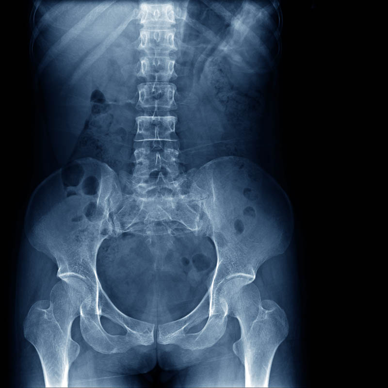 Motorcycle Accident Attorney